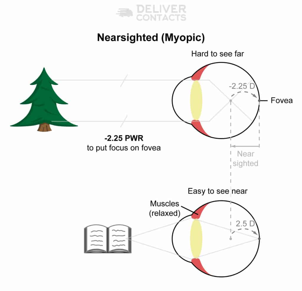 Diagram of the impact of myopia (nearsightedness) on the eye