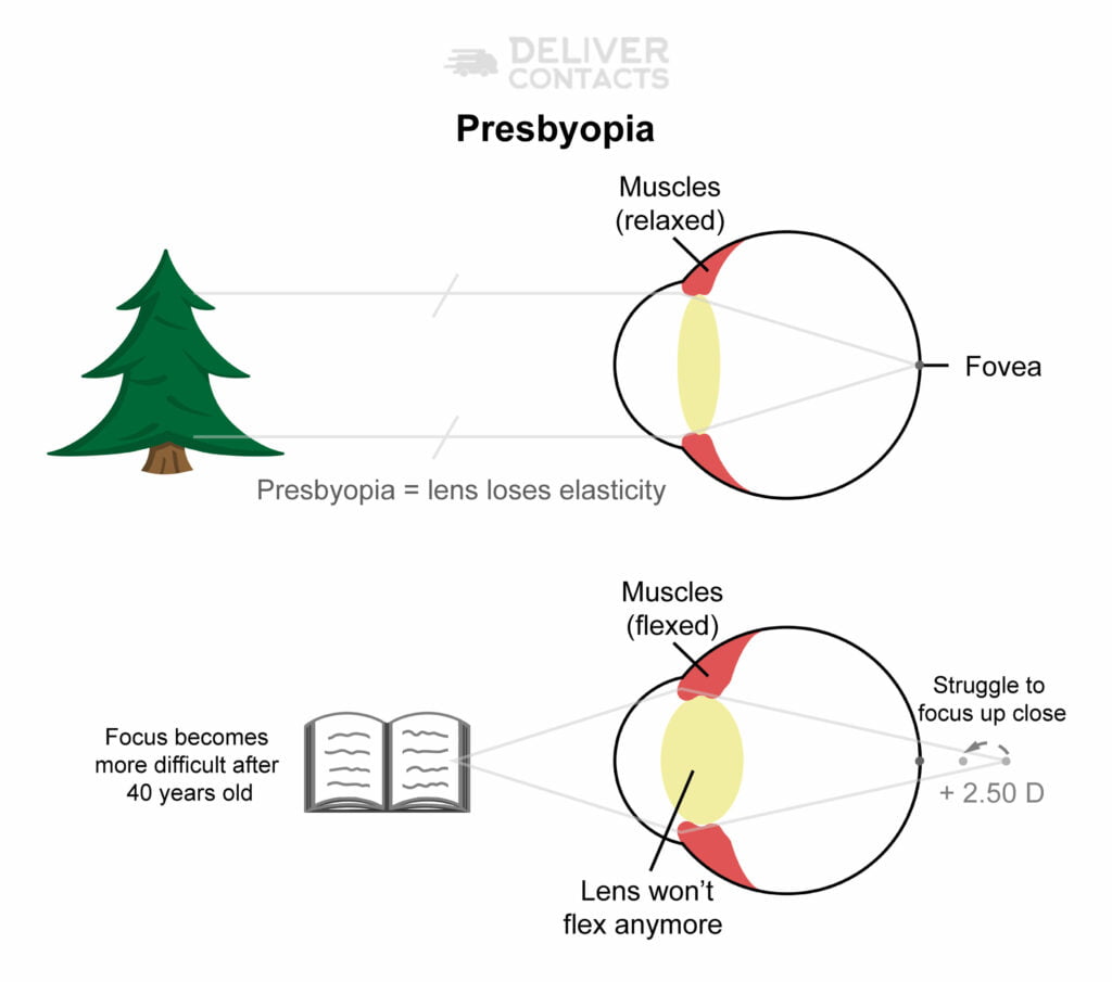 Presbyopia is the slow loss of flexibility of the crystalline lens in the eye behind the pupil. This slow loss of flexibility is why we need bifocals, trifocals, or progressives to help up close.