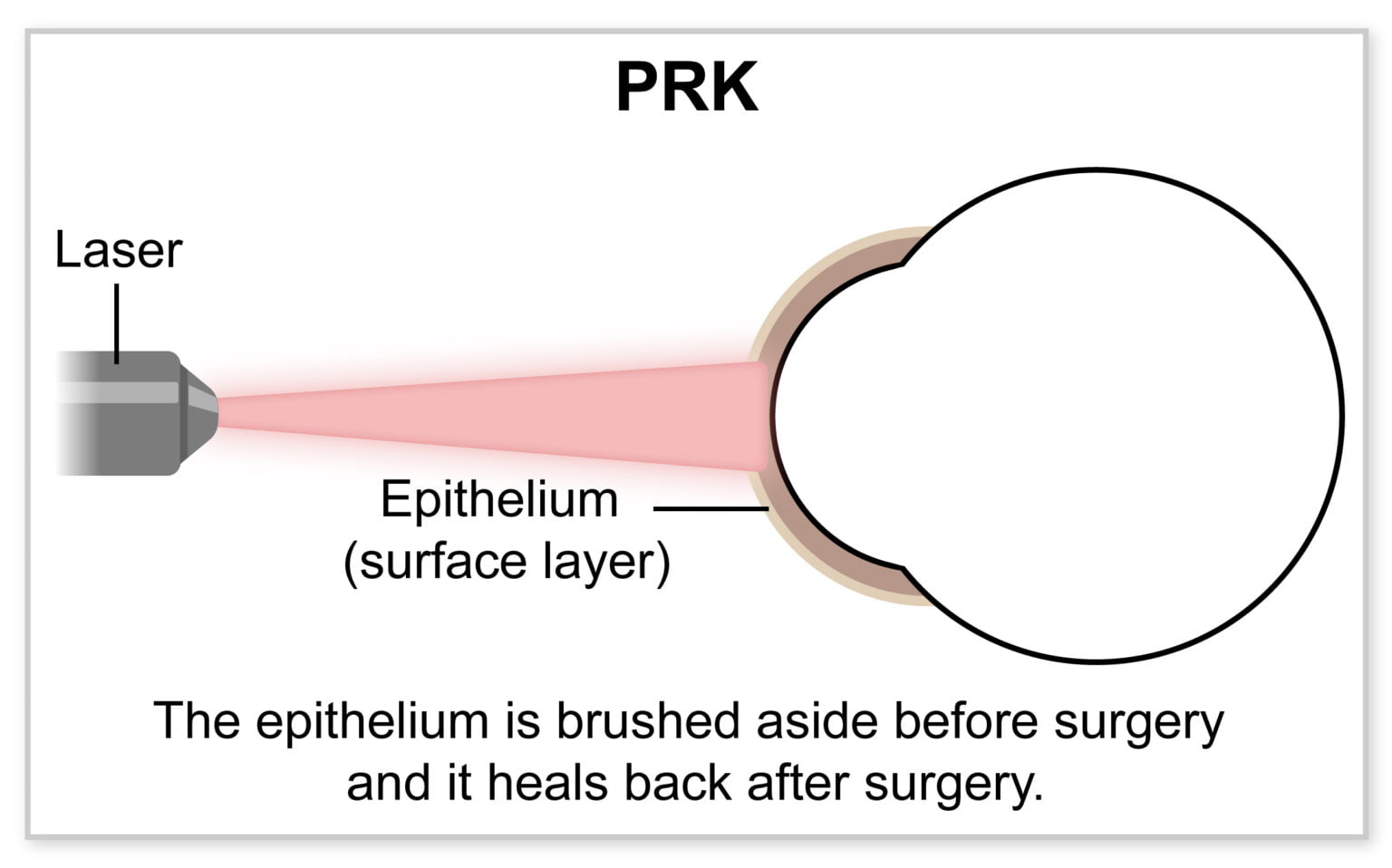 What Is PRK Eye Surgery? Deliver Contacts