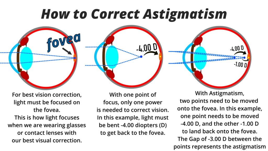 This image demonstrates the difference between corrected vision, versus uncorrected spherical refractive error, versus uncorrected astigmatism refractive error