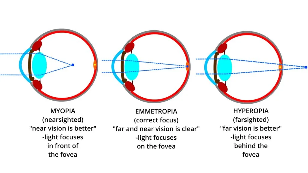 Emmetropia vs. Myopia vs. Hyperopia focal points This image demonstrates how light focuses with emmetropia (normal focus), myopia (nearsighted), and hyperopia (farsighted)