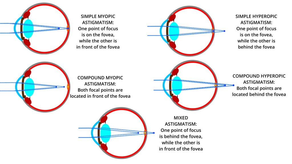 This image lists the different forms of astigmatism and includes term identification such as simple, compound, mixed, myopic, and hyperopic