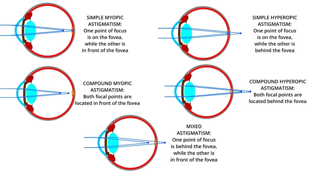 Forms of Astigmatism This image lists the different forms of astigmatism and includes term identification such as simple, compound, mixed, myopic, and hyperopic
